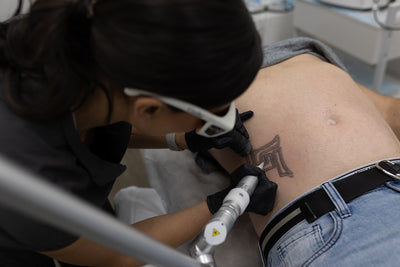 LAser tattoo removal